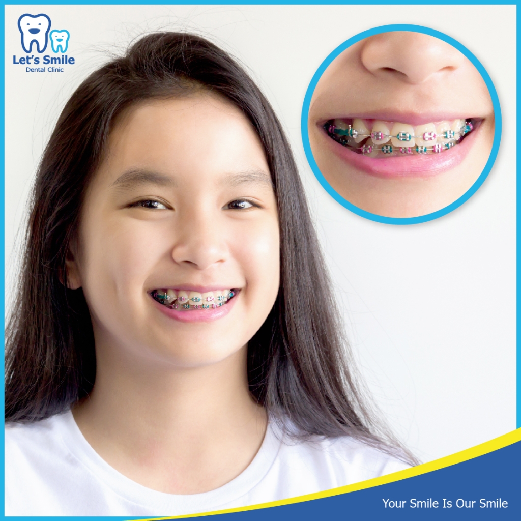 Orthodontics (Braces) | Let's Smile Dental Clinic